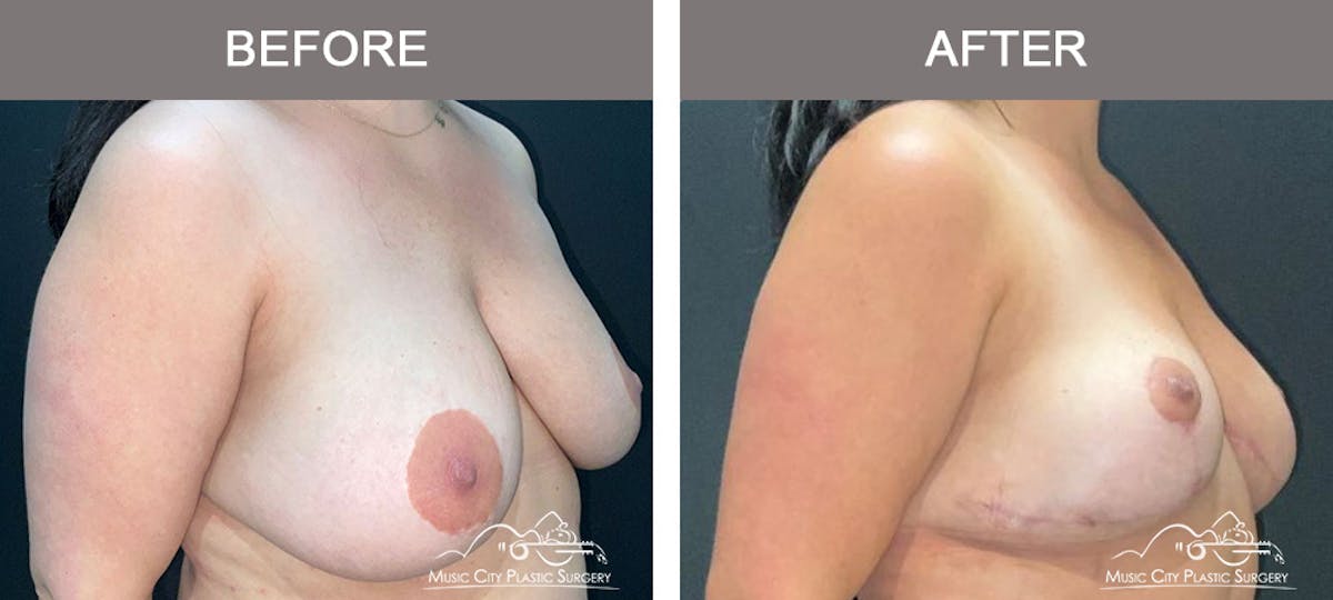 Mastopexy with Capsulectomy Before & After Gallery - Patient 408362 - Image 2