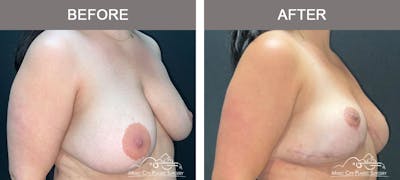 Mastopexy with Capsulectomy Before & After Gallery - Patient 408362 - Image 2