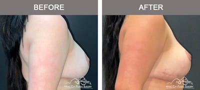 Mastopexy with Capsulectomy Before & After Gallery - Patient 408362 - Image 3