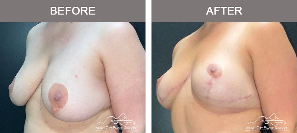 Mastopexy with Capsulectomy Before & After Gallery - Patient 408362 - Image 4