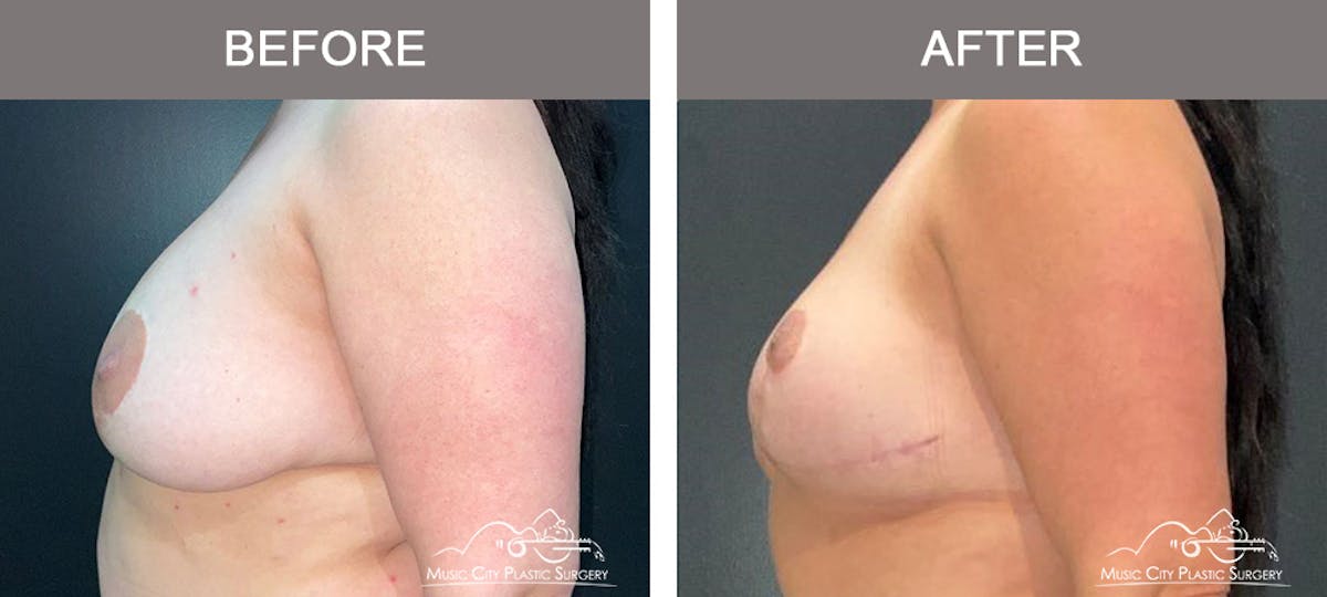Mastopexy with Capsulectomy Before & After Gallery - Patient 408362 - Image 5