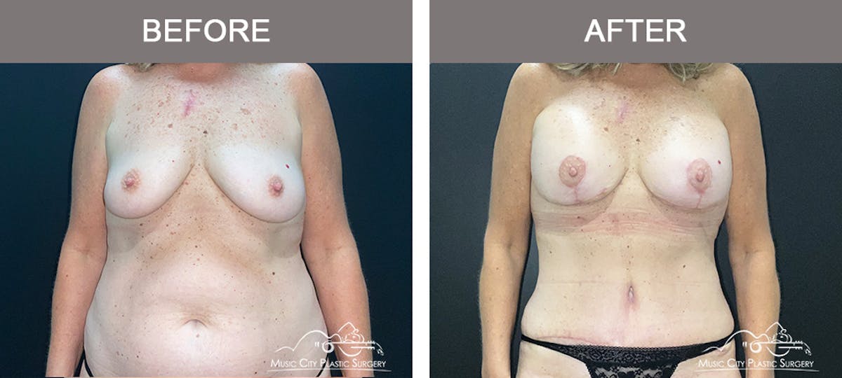 Breast Lift Before & After Gallery - Patient 173382 - Image 1