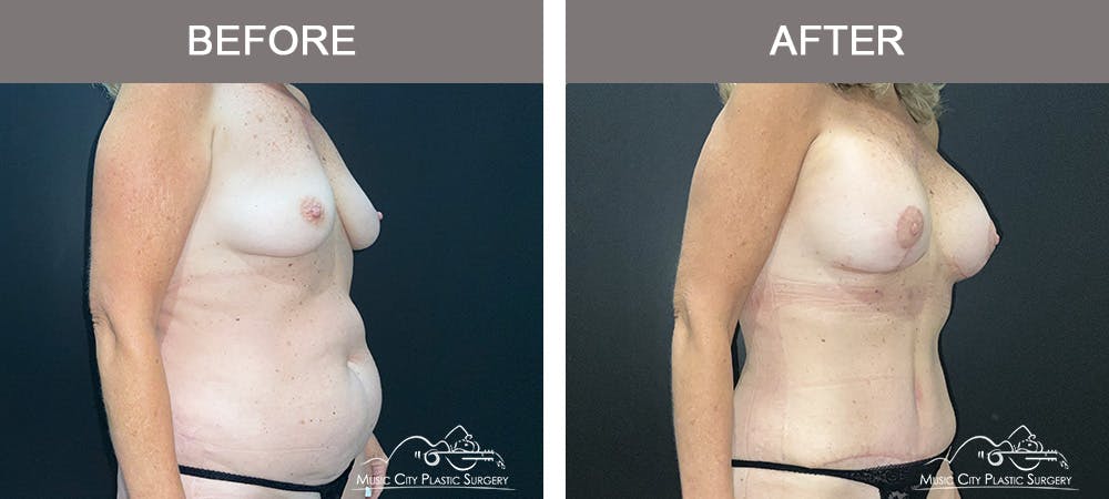 Breast Lift Before & After Gallery - Patient 173382 - Image 2