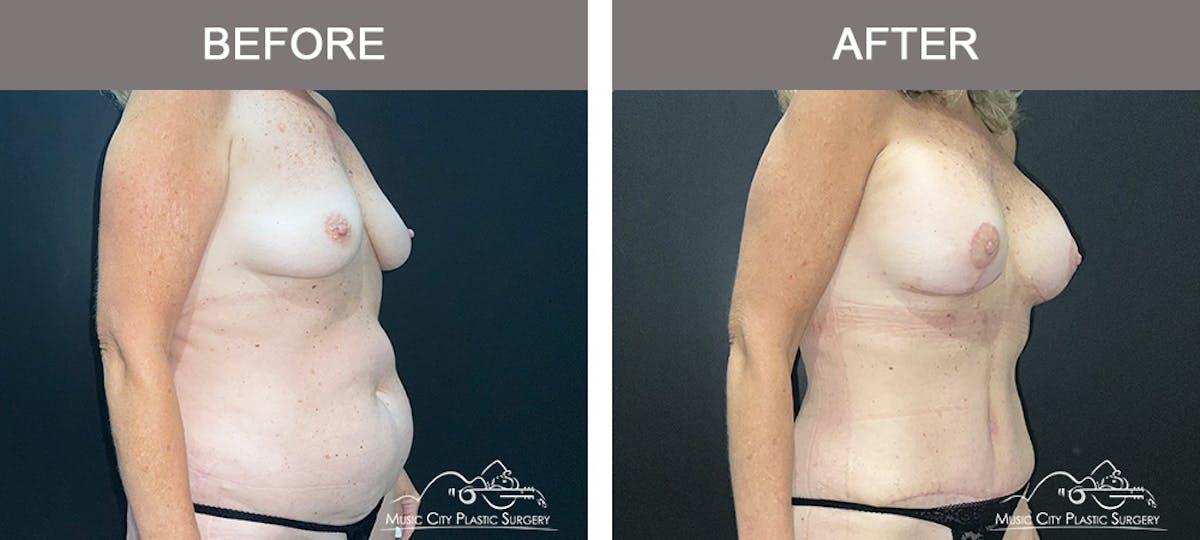 Abdominoplasty Before & After Gallery - Patient 156401 - Image 2