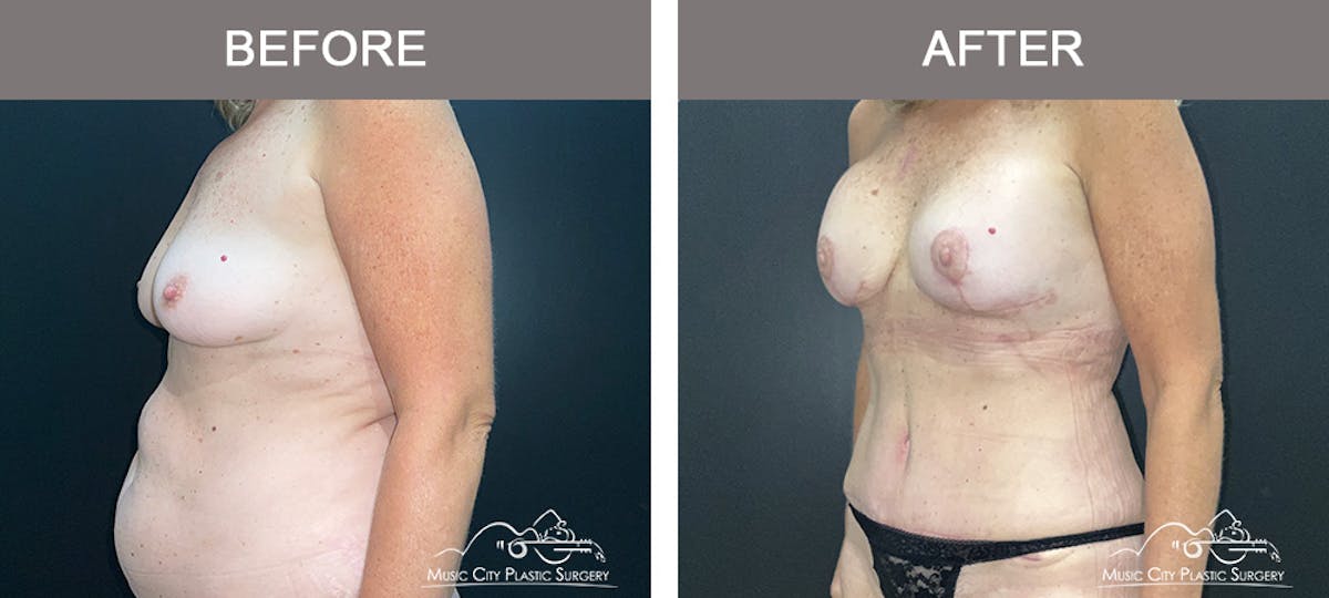 Breast Augmentation Before & After Gallery - Patient 906062 - Image 3