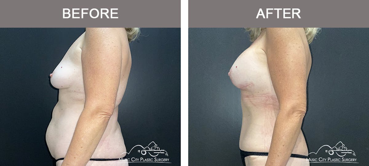 Abdominoplasty Before & After Gallery - Patient 156401 - Image 4