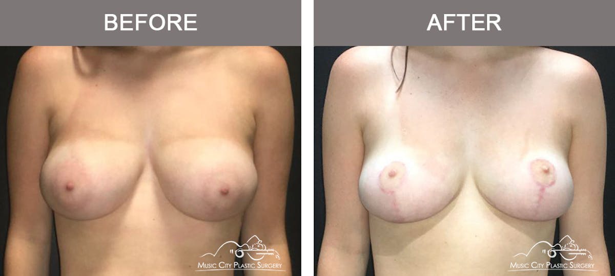 Breast Reduction Before & After Gallery - Patient 249764 - Image 1