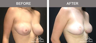 Breast Reduction Before & After Gallery - Patient 249764 - Image 2