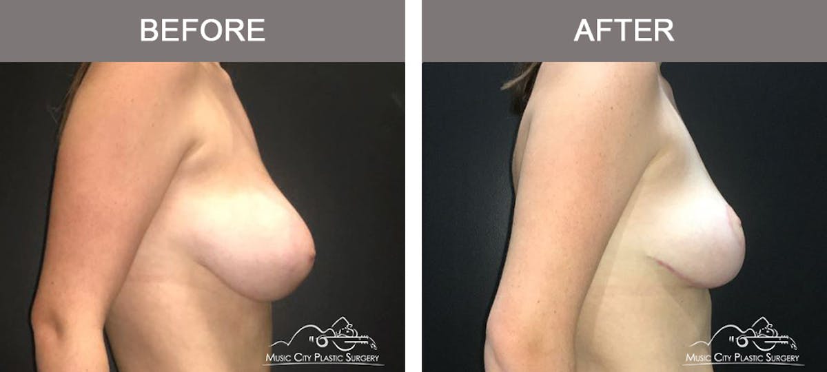 Breast Reduction Before & After Gallery - Patient 249764 - Image 3