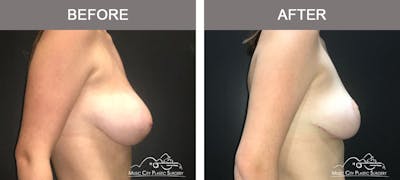 Breast Reduction Before & After Gallery - Patient 249764 - Image 3