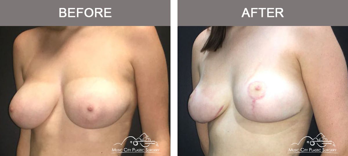 Breast Reduction Before & After Gallery - Patient 249764 - Image 4