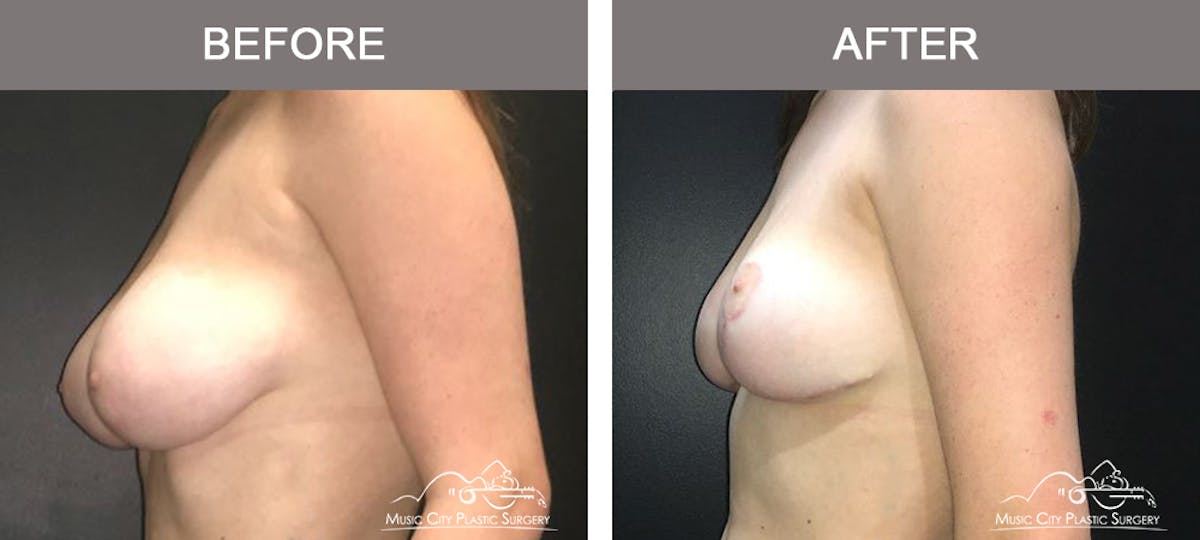 Breast Reduction Before & After Gallery - Patient 249764 - Image 5