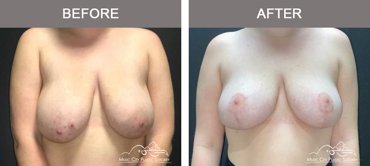 Breast Reduction Before & After Gallery - Patient 395858 - Image 1
