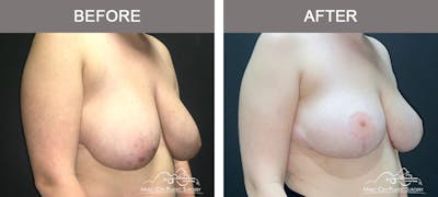 Breast Reduction Before & After Gallery - Patient 395858 - Image 2