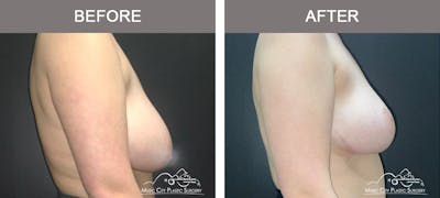 Breast Reduction Before & After Gallery - Patient 395858 - Image 3