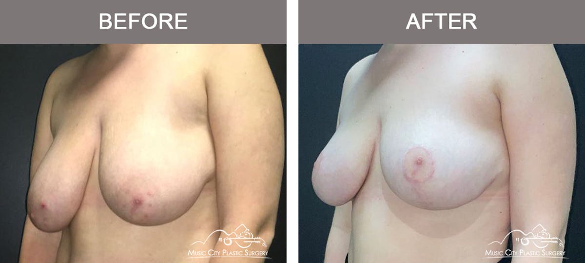 Breast Reduction Before & After Gallery - Patient 395858 - Image 4