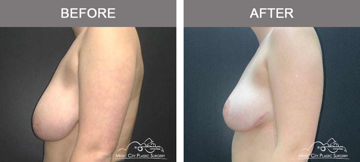 Breast Reduction Before & After Gallery - Patient 395858 - Image 5