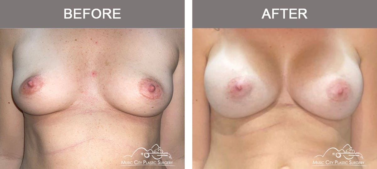 Breast Augmentation Before & After Gallery - Patient 153780 - Image 1