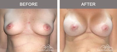 Breast Augmentation Before & After Gallery - Patient 153780 - Image 1