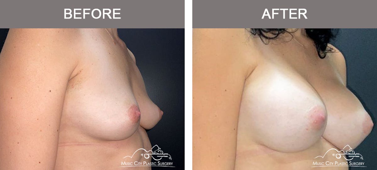 Breast Augmentation Before & After Gallery - Patient 153780 - Image 2