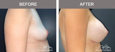 Breast Augmentation Before & After Gallery - Patient 153780 - Image 3