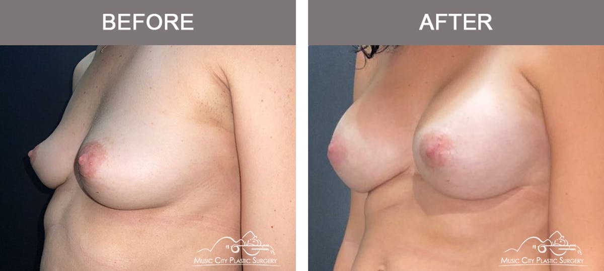 Breast Augmentation Before & After Gallery - Patient 153780 - Image 4