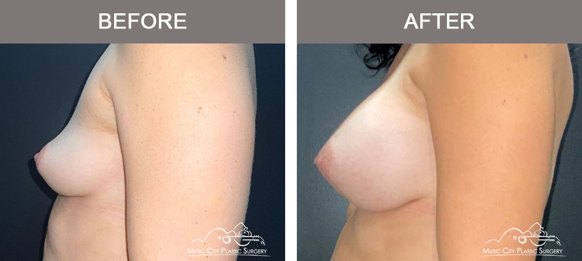 Breast Augmentation Before & After Gallery - Patient 153780 - Image 5