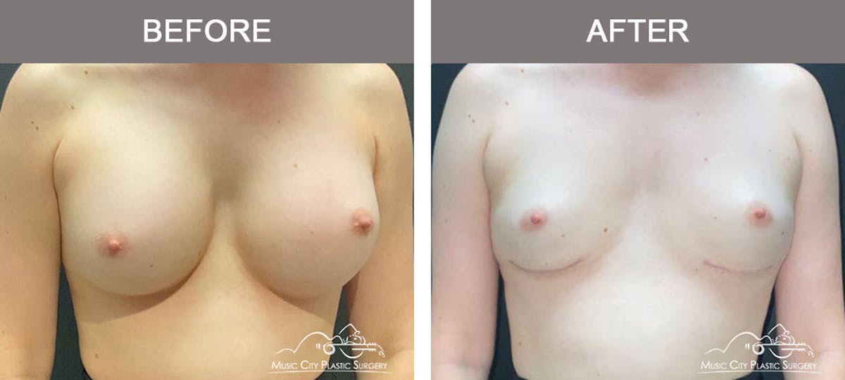 Liposuction Before & After Gallery - Patient 340433 - Image 1