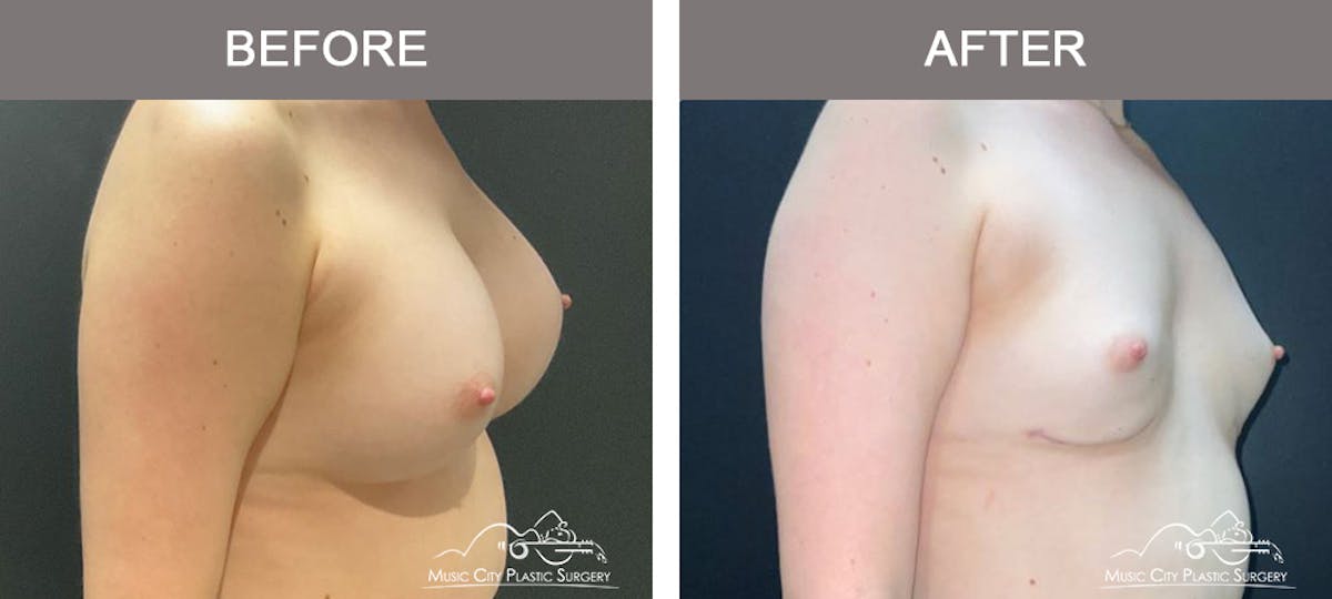 Liposuction Before & After Gallery - Patient 340433 - Image 2