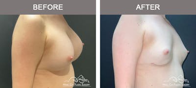 Liposuction Before & After Gallery - Patient 340433 - Image 2