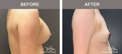 Capsulectomy Before & After Gallery - Patient 226870 - Image 3