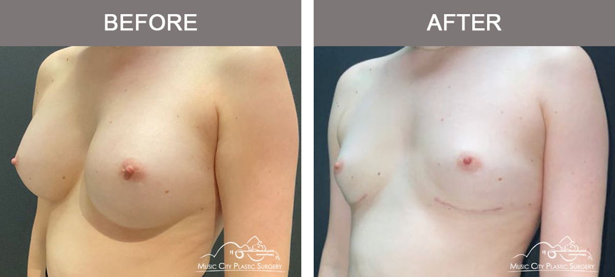 Liposuction Before & After Gallery - Patient 340433 - Image 4