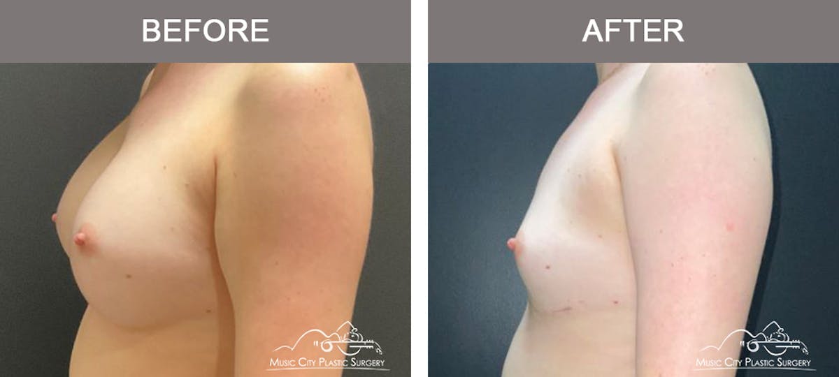 Liposuction Before & After Gallery - Patient 340433 - Image 5