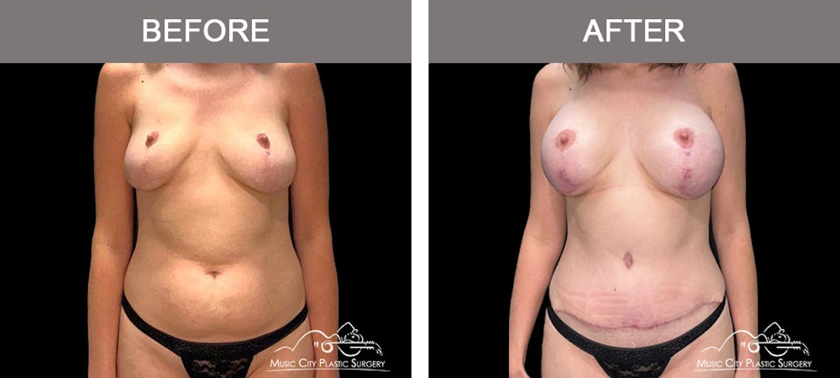 Abdominoplasty Before & After Gallery - Patient 213485 - Image 1