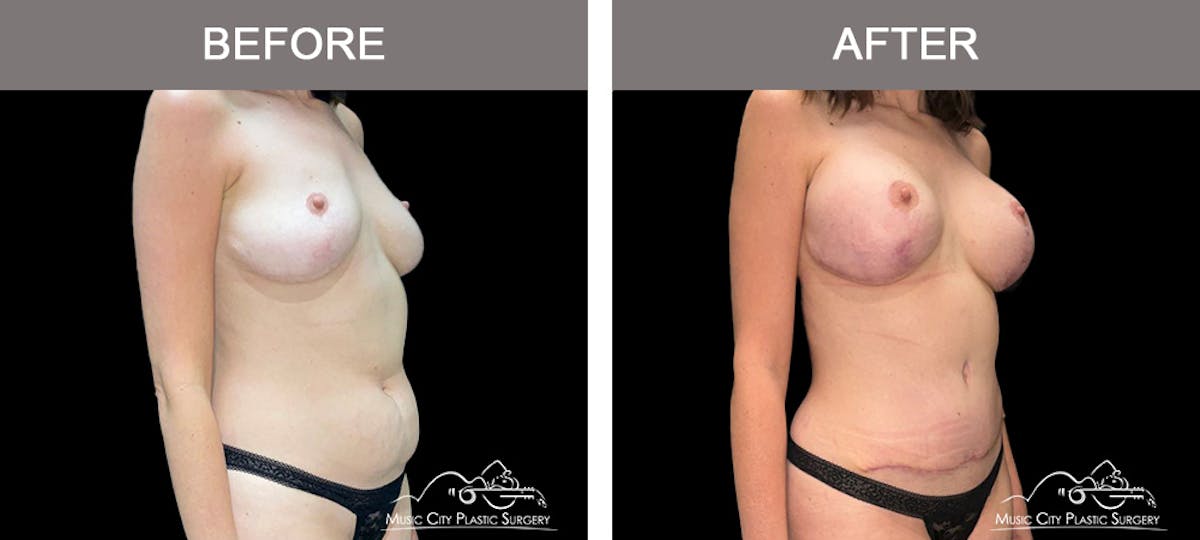 Abdominoplasty Before & After Gallery - Patient 213485 - Image 2