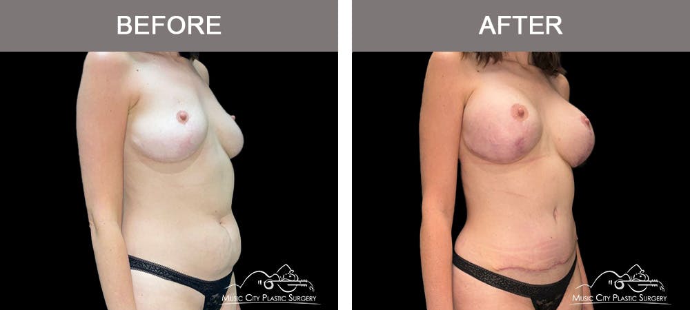 Liposuction Before & After Gallery - Patient 349589 - Image 2