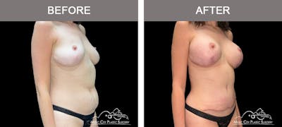 Breast Augmentation Before & After Gallery - Patient 392003 - Image 2