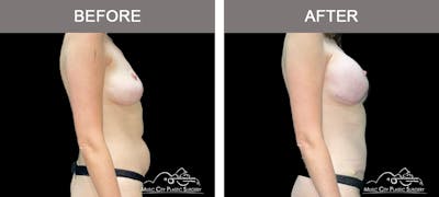 Breast Augmentation Before & After Gallery - Patient 392003 - Image 3