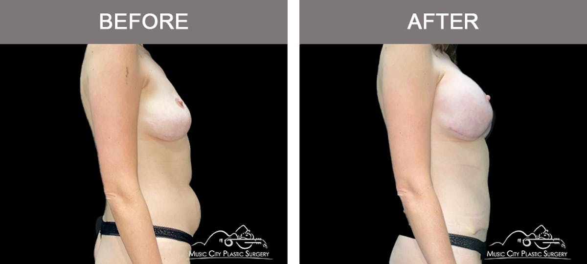 Breast Lift Before & After Gallery - Patient 391093 - Image 3