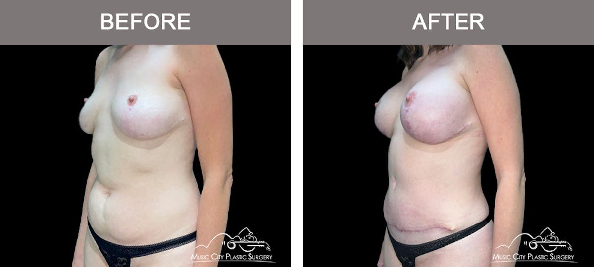 Liposuction Before & After Gallery - Patient 349589 - Image 4