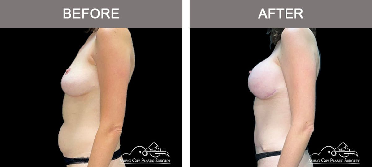 Liposuction Before & After Gallery - Patient 349589 - Image 5