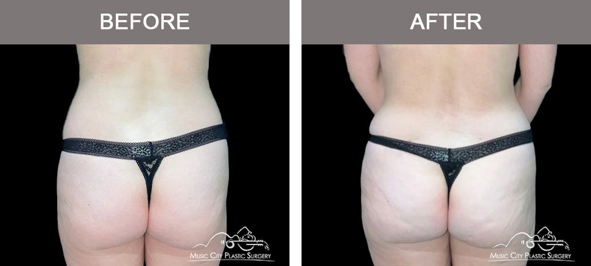 Liposuction Before & After Gallery - Patient 349589 - Image 6