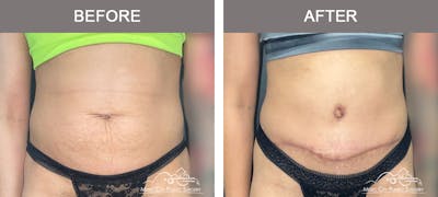 Liposuction Before & After Gallery - Patient 333821 - Image 1
