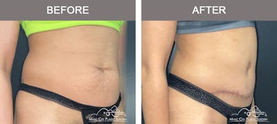 Liposuction Before & After Gallery - Patient 333821 - Image 2