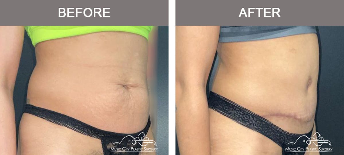 Abdominoplasty Before & After Gallery - Patient 207123 - Image 2