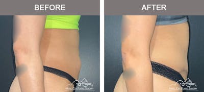 Abdominoplasty Before & After Gallery - Patient 207123 - Image 3