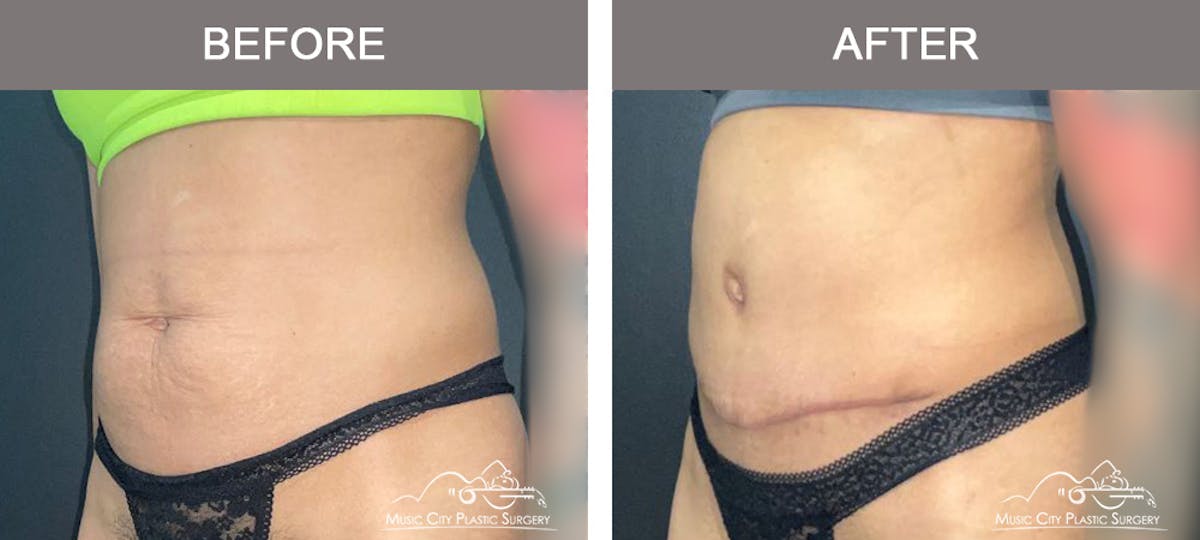 Liposuction Before & After Gallery - Patient 333821 - Image 4