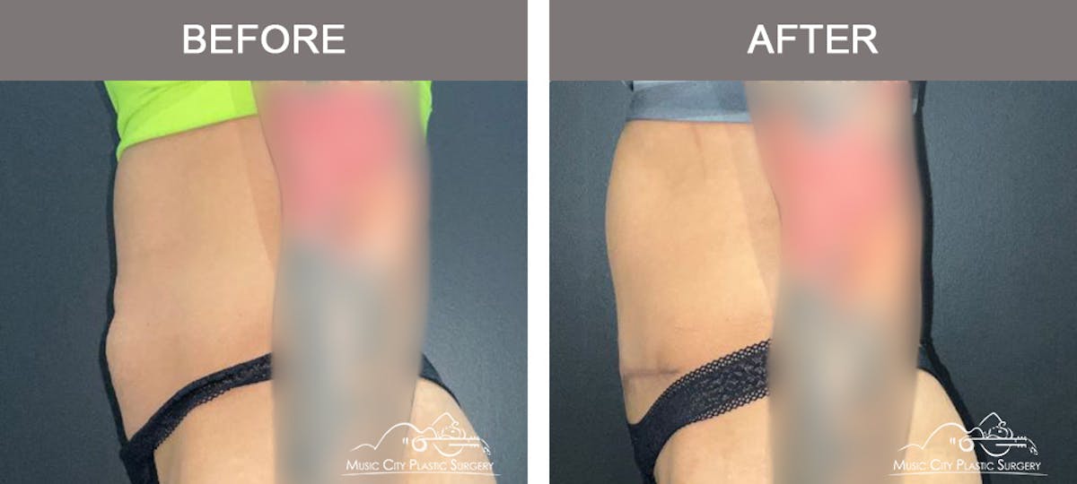 Liposuction Before & After Gallery - Patient 333821 - Image 5