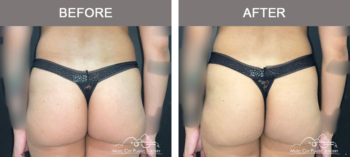 Abdominoplasty Before & After Gallery - Patient 207123 - Image 6