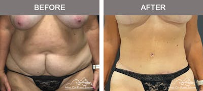 Liposuction Before & After Gallery - Patient 373727 - Image 1